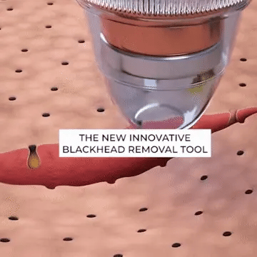 Easy Mart® Blackheads Remover Vacuum